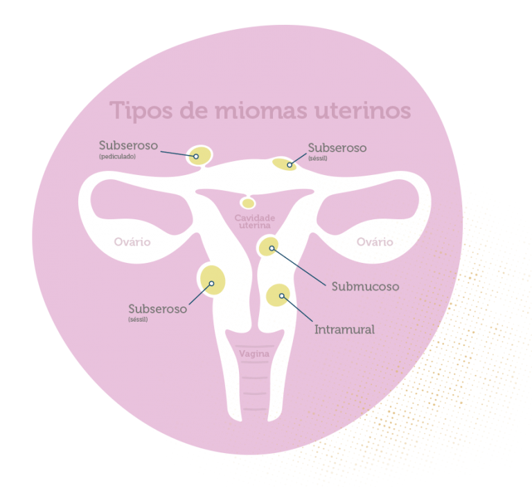 Miomas uterinos Clínica Elo