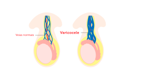 O que é varicocele? Saiba mais sobre a doença - Elo Medicina Reprodutiva